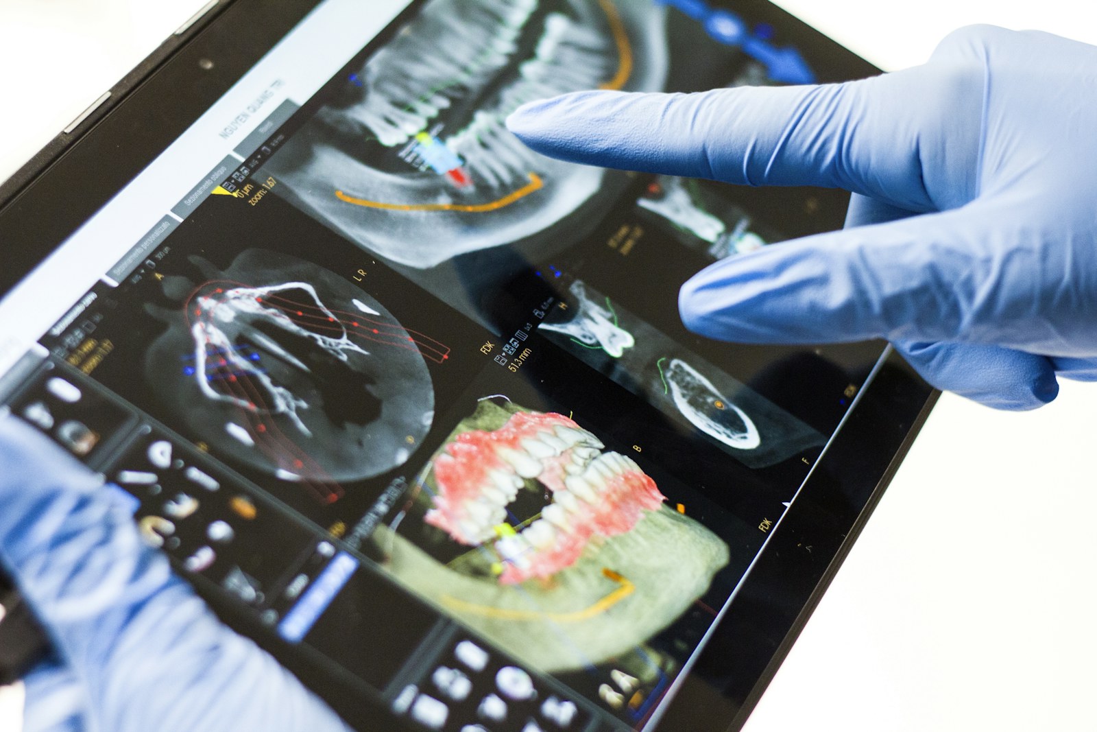 Dental CBCT implant planning on a tablet